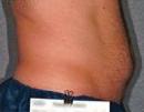 Liposonix