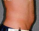 Liposonix