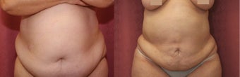 liposuction of abdomen and flanks of woman from Los Angeles