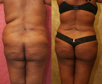 Brazilian buttock augmentation with fat grafting to the buttocks with liposuction in Los Angeles