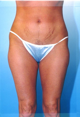 liposuction of thighs for women