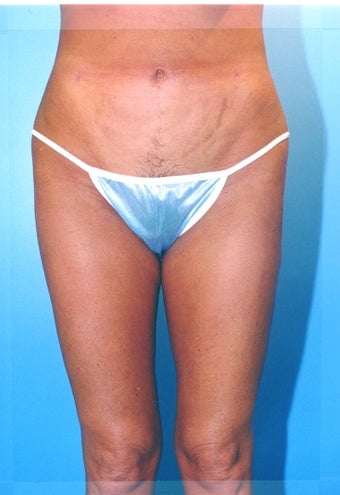 liposuction of thighs for women
