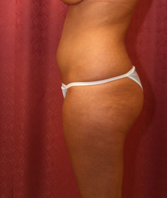 liposuction of thighs for women