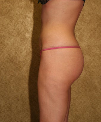 liposuction of thighs for women