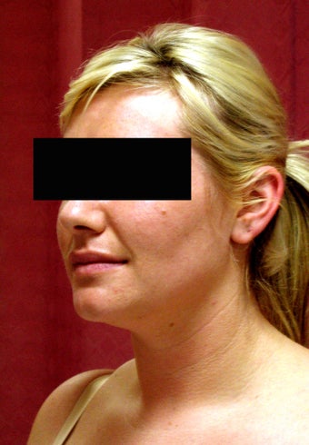 liposuction of neck & jaw line for women