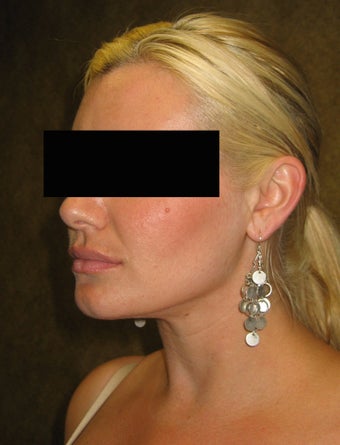 liposuction of neck & jaw line for women