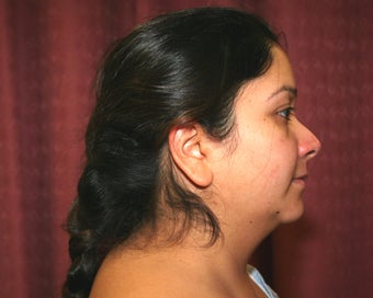 liposuction of neck & jaw line for women in Los Angeles