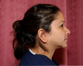 liposuction of neck & jaw line for women in Los Angeles