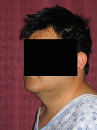 Liposuction of neck & jaw line for men
