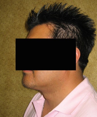 Liposuction of neck & jaw line for men