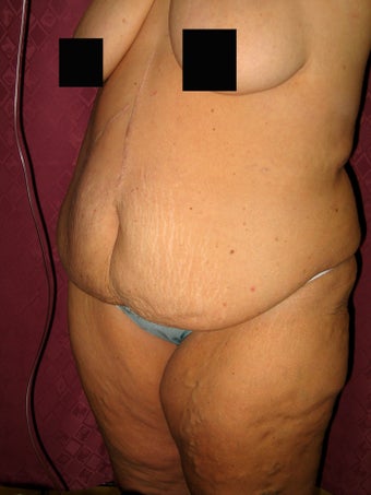 Body Lift after massive weight loss in los Angeles