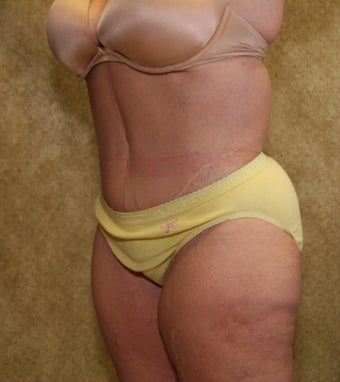 Body Lift after massive weight loss in los Angeles