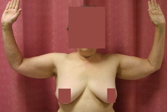 Brachioplasty or arm tuck in los angeles