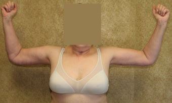 Brachioplasty or arm tuck in los angeles