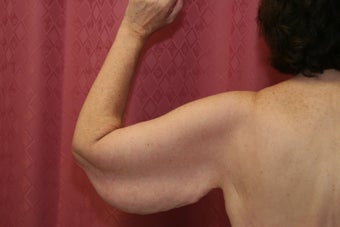 Brachioplasty or arm tuck in los angeles