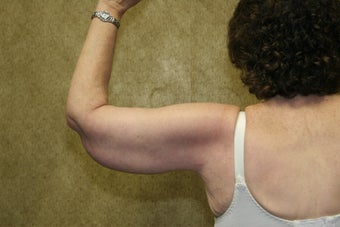 Brachioplasty or arm tuck in los angeles