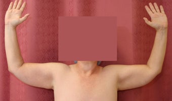 Brachioplasty or arm tuck