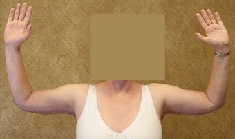 Brachioplasty or arm tuck