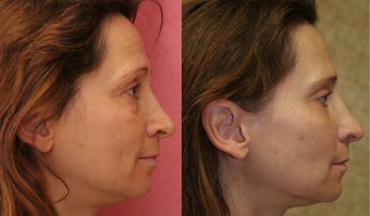 Eyelid surgery or blepharoplasty