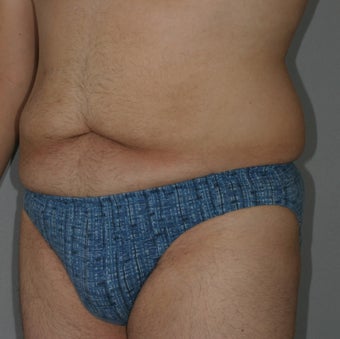 Male Abdominoplasty