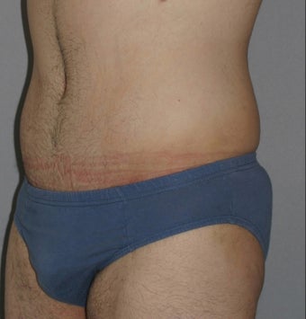 Male Abdominoplasty