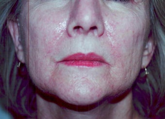 SmartXide CO2 Laser Resurfacing (DOT Therapy)