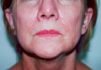 SmartXide CO2 Laser Resurfacing (DOT Therapy)