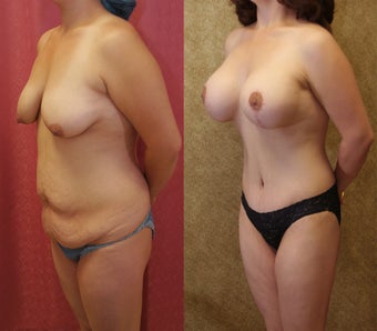 Tummy tuck with breast lift
