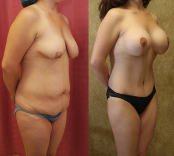 Tummy tuck with breast lift