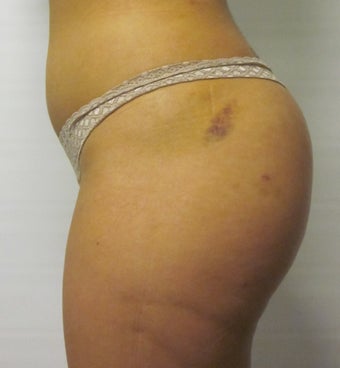 Brazilian Butt Lift 
