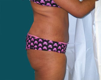 Buttocks augmentation with implants and fat grafting