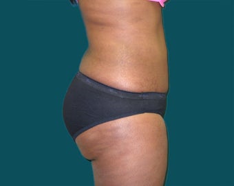 Buttocks augmentation with implants and fat grafting