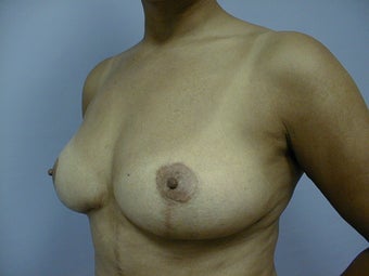 Breast Implant Removal and Lift