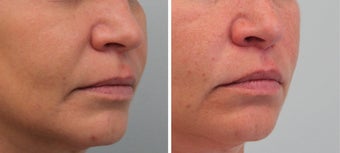 Bullhorn Lip Lift