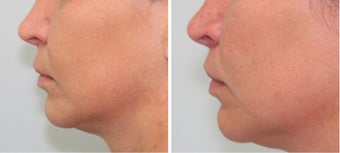 Bullhorn Lip Lift