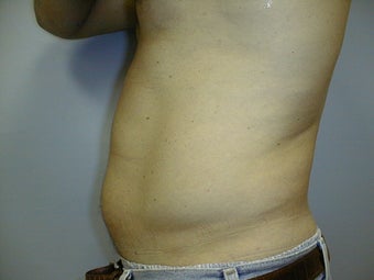 Male contouring liposuction