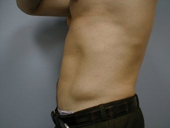Male contouring liposuction
