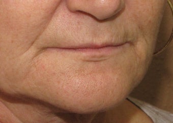 Lip lift