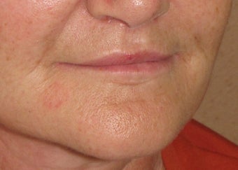 Lip lift
