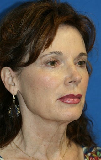 Facelift, Fat Transfer, and Skin Pinch