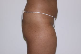 Brazilian Butt Lift