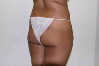 Brazilian Butt Lift