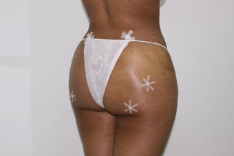 Brazilian Butt Lift