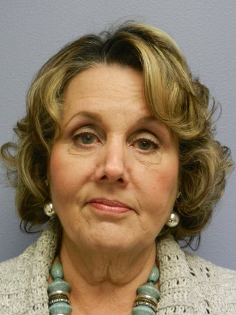 Neck Lift 
