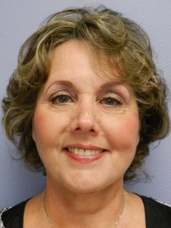 Neck Lift 
