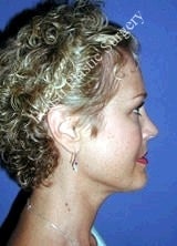 Liposuction