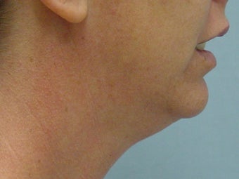 Ultherapy of Face