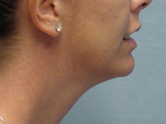 Ultherapy of Face