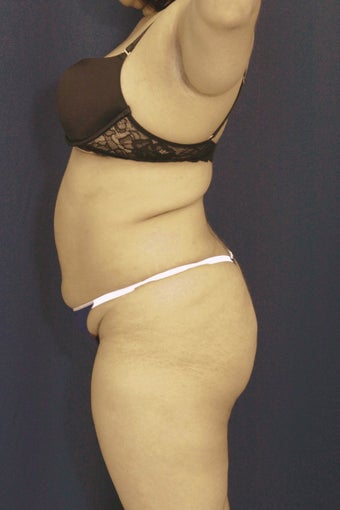 Brazilian Butt Lift surgery (liposuction to multiple areas and fat grafting to buttock)