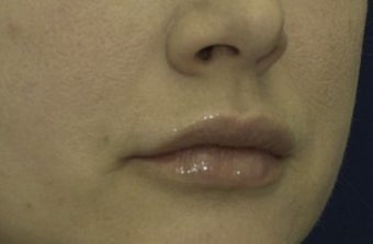 Lip Lift